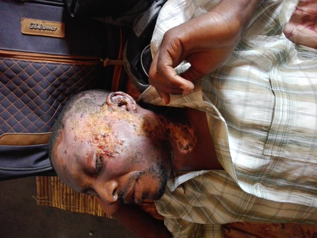 Burnt Victim’s Plea for Help After Desperate Escape from Hospital